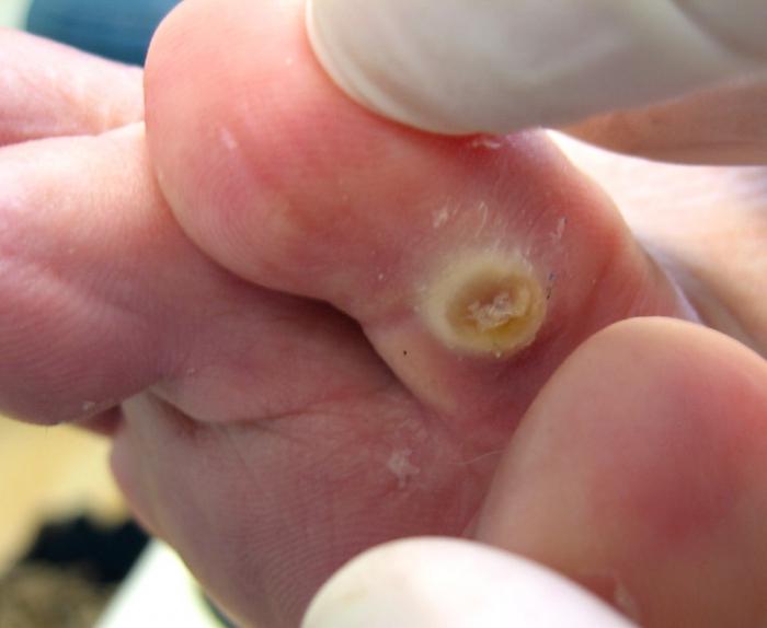 Calluses on foot Causes And Avoidance: Corn On The Feet