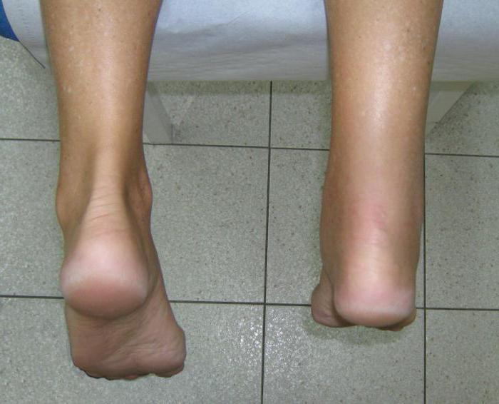simptomi liječenja artroze zgloba koljena mogu biti