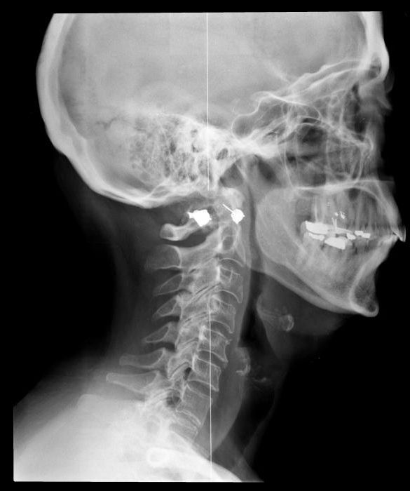 Skull Cervical X Ray Pdf