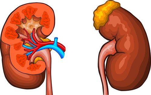 Uremia A Uremia Punca Gejala Dan Rawatan