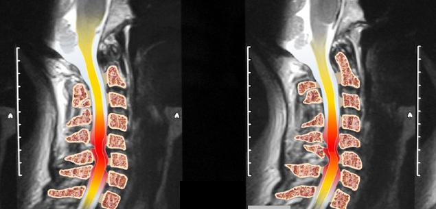 Lumbosacral ম র দণ ড এমআরআই ভ তর প য থলজ কট ক ষপ ত