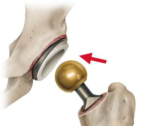 acetabulum anatomy,Acetabulum Of The  Pelvis