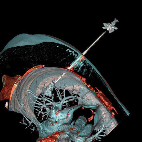 lung biopsy recovery  @ Lung Biopsy: Towards An Appointment, Outcome And Outcome