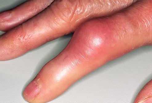 bol u zglobovima prstiju donjih ekstremiteta
